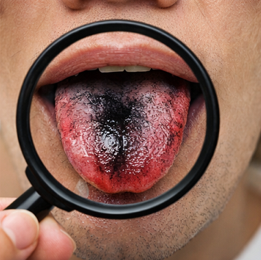검은 혀와 이상 증상 확인을 위한 확대 이미지