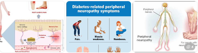 당뇨병으로 인한 신경 손상