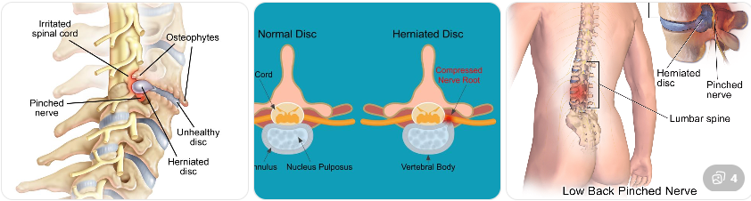 신경 압박으로 인한 손발 저림
