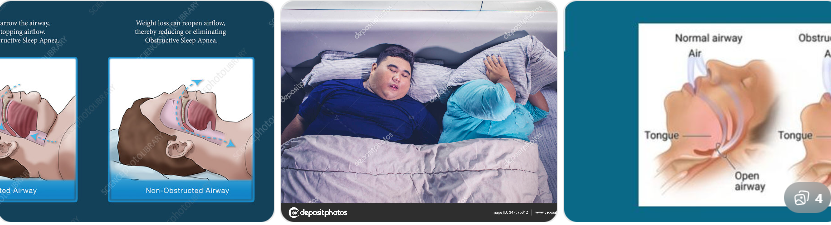 비만과 코골이 관계