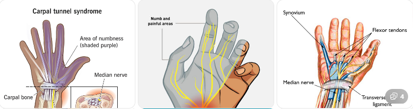 손목 터널 증후군