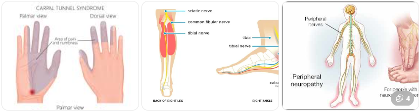 손발 저림이란 무엇인가