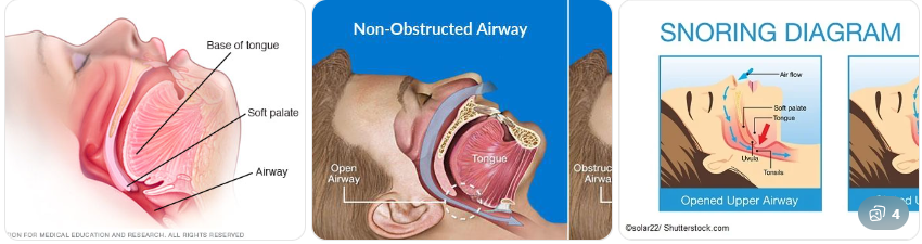 코골이 발생 원리 (기도 구조)