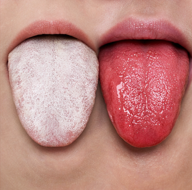 혀 백태와 정상 혀 색깔 비교로 보는 건강 상태