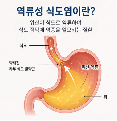 역류성 식도염 원인 위산 역류 구조 식도 괄약근 약화 설명 이미지