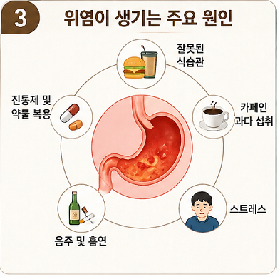 위염 원인 식습관 스트레스 카페인 영향 설명 이미지