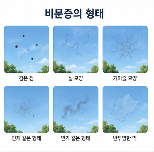 검은 점·실모양·거미줄 형태의 비문증 증상을 설명
