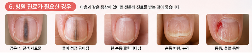 병원 진료가 필요한 손톱 세로줄