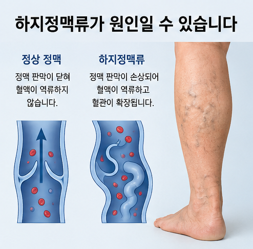 정상 정맥과 하지정맥류의 차이를 비교하며 종아리 붓기 원인을 설명하는 의료 일러스트