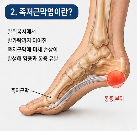 족저근막염의 발생 원리와 통증 부위를 보여주는 발 구조 해설