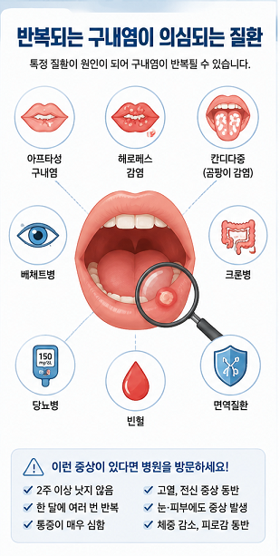 반복되는 구내염이 의심되는 질환
