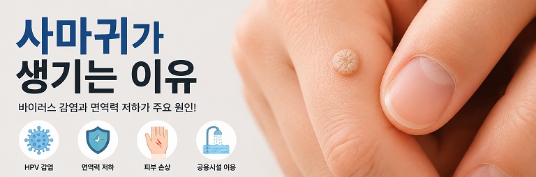 사마귀가 생기는 이유