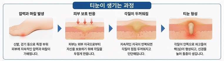 티눈이 생기는 과정